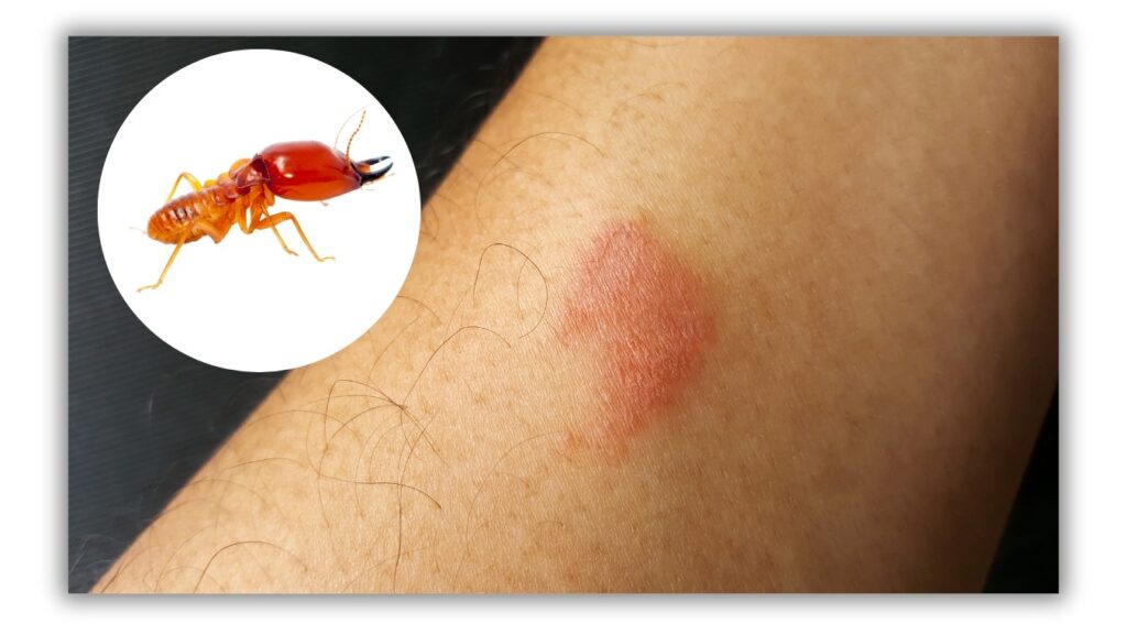 Termite Bug Bite on Human